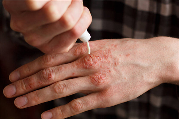 湿疹是由什么原因造成的