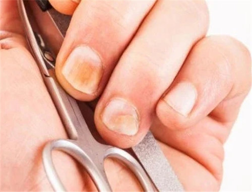 灰指甲的表现症状以及形成原因 如何治疗灰指甲