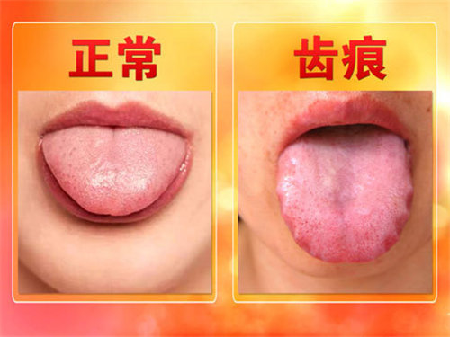 湿气重的人舌苔是什么样的 湿气重的表现