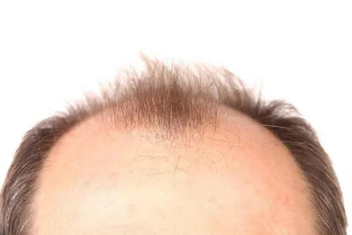 男人秃顶形成的原因 男性秃顶怎么办