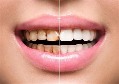 牙结石用什么牙膏 如何去除牙结石