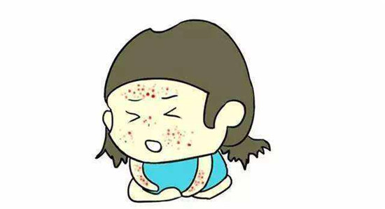 秋天为什么容易导致荨麻疹 荨麻疹患者需要注意什么